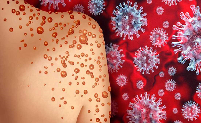 venezuela-caso-viruela-700